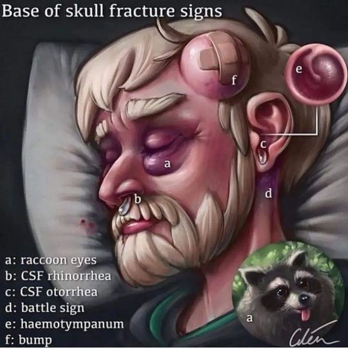 Signs of skull fracture