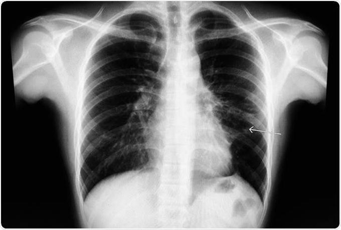 Symptoms of mediastinitis
