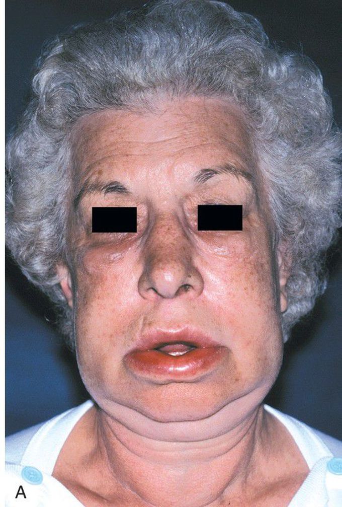 Angioedema