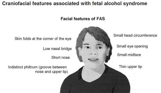Feature of fetal alcohol syndrome