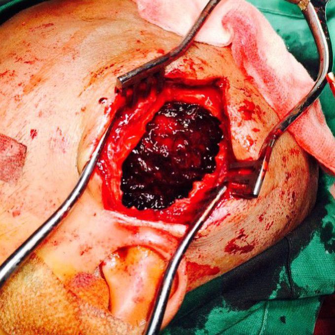 Epidural hematoma