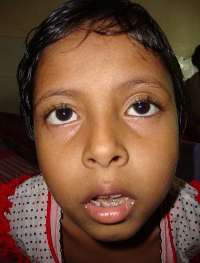 adenoid face syndrome