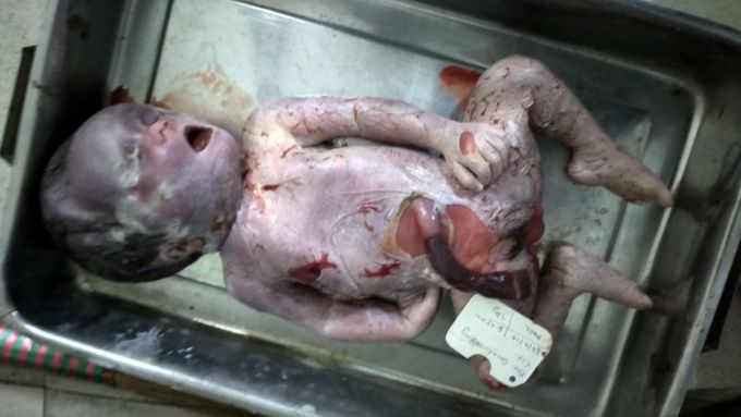 Intrauterine Fetal Demise