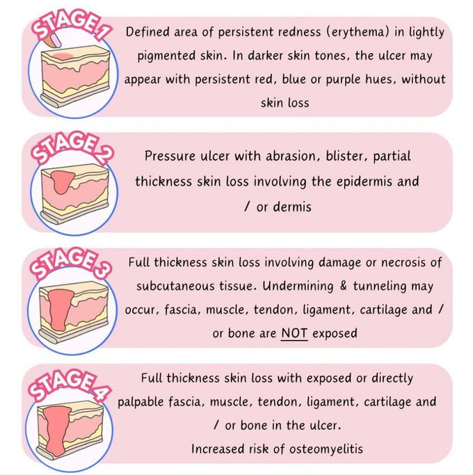 Pressure Ulcer Stages