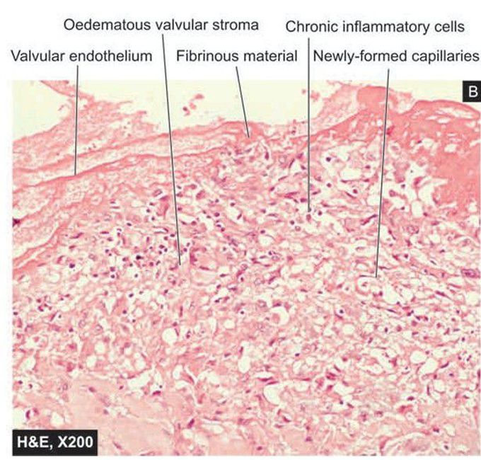 Infective endocarditis