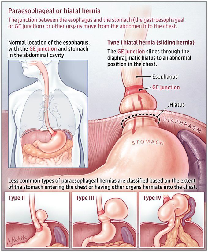 Hiatal Hernia