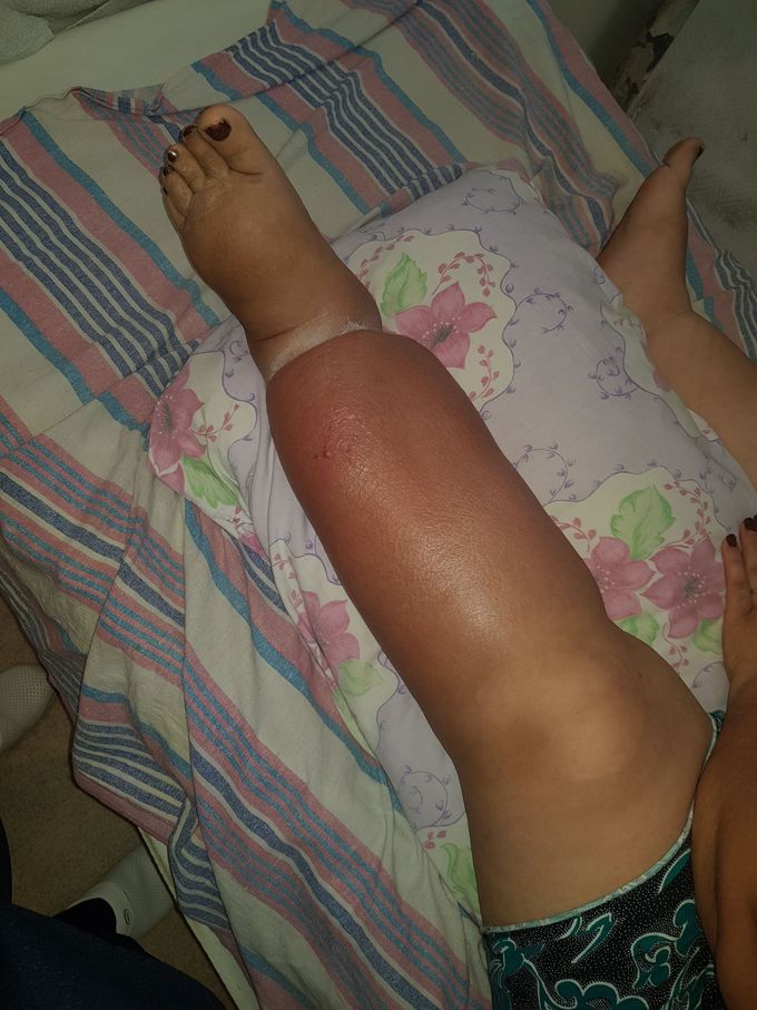 Erysipelas after treatment third day with penicilline G. 2000000x3