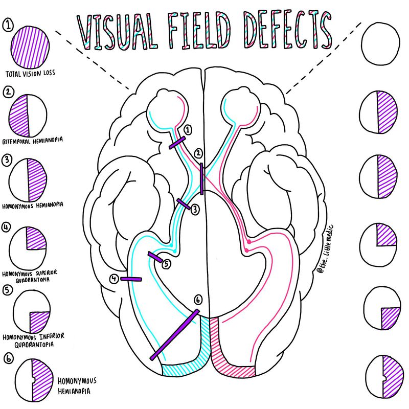 Visual Field Defects Medizzy 