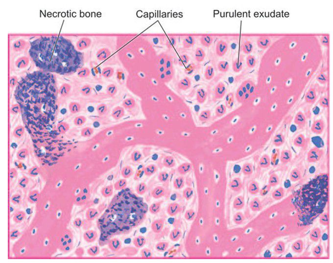 Chronic suppurative osteomyelitis.