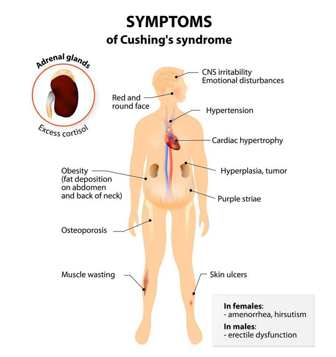 Cushing's syndrome