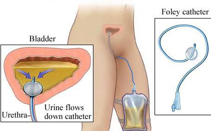 Foley's catheter