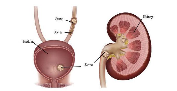 Symptoms of renal colic