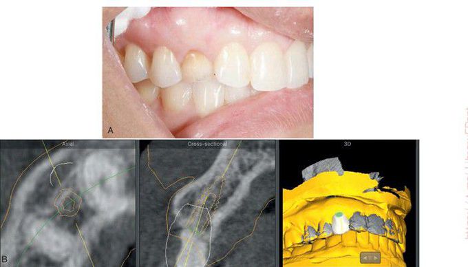 Immediate implant