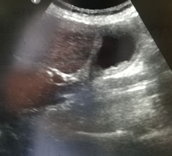 Diagnosis? Upper abdominal cross right