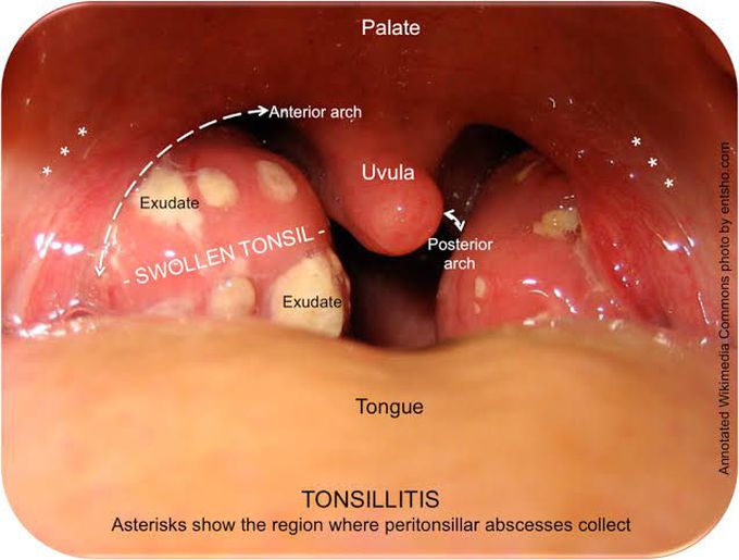 Peritonsillar abscess causes
