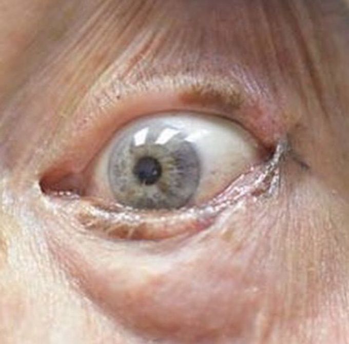 Melanoma en Párpado.