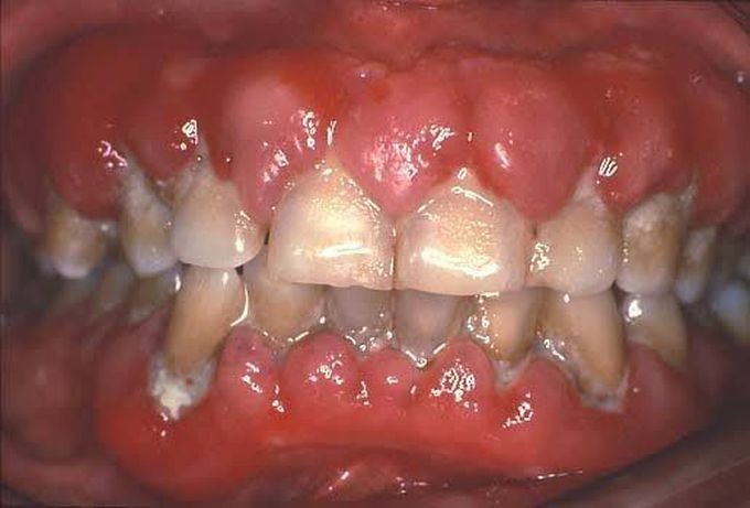 Gingival enlargement