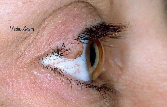 Eyelid Papilloma