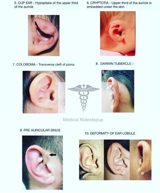 Outer Ear Pathologies-III