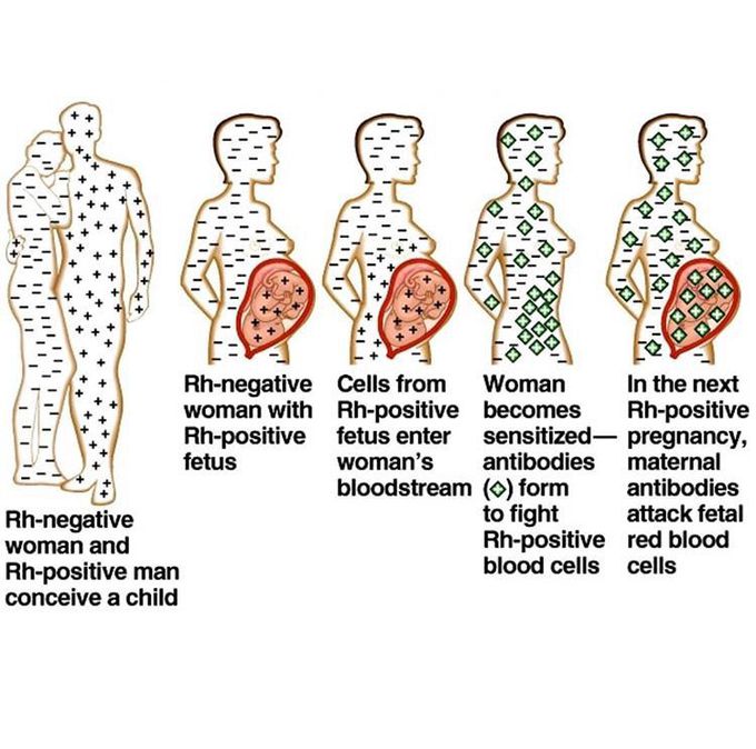 Rh Mother-foetus incompatibility