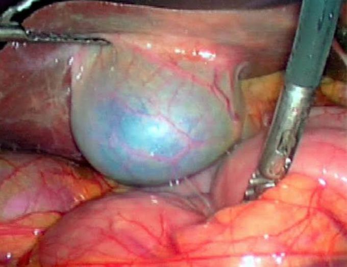 Gall stones removal surgery