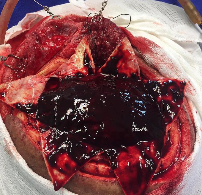 Massive subdural hematoma over the surface of the brain!! 