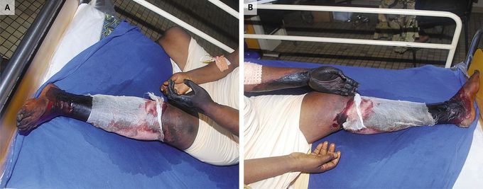 Simultaneous Gangrene of Both Left Extremities