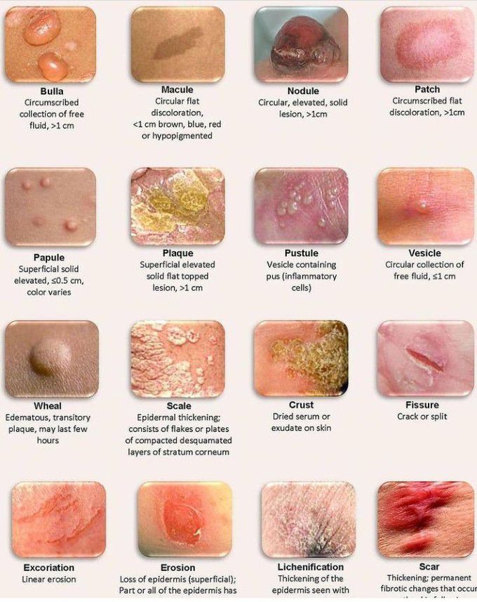 Types of skin lesions