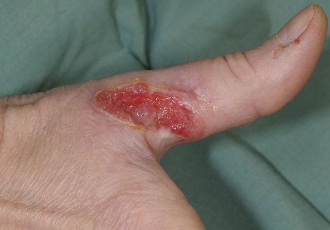 Squamous-Cell Carcinoma Resembling Pyoderma Gangrenosum