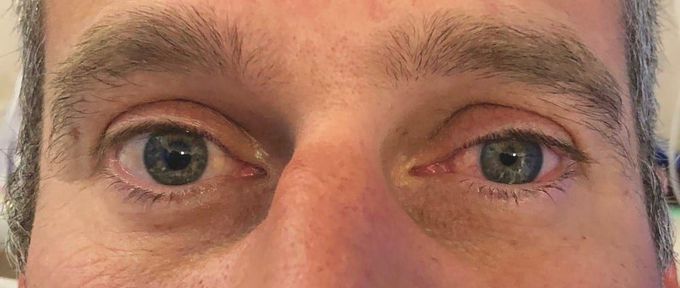 Horner's syndrome