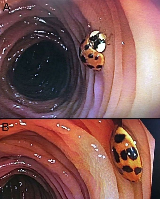 A Living Ladybug Inside The Colon!