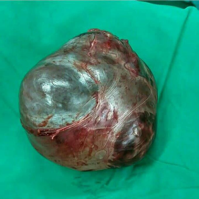 A huge cyst in the right ovary of a 50 yrs old femal patient cystoctomy with pfannenstiel incision