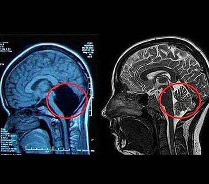 CEREBRAL AGENESIS