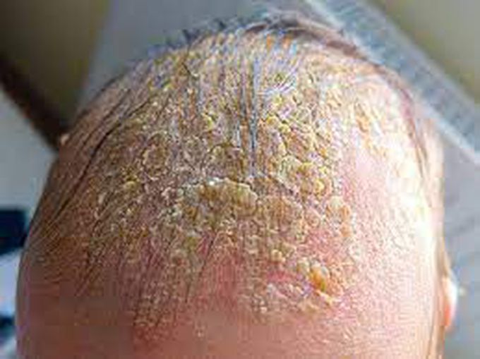 Symptoms of Cradle Cap