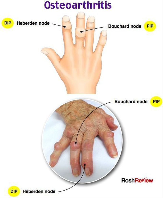 Osteoarthritis | Orthopedic nursing, Nursing school survival, Nursing study