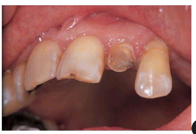 Hypersensitivity to impression material