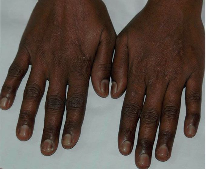Hyperpigmentation and vegetarianism