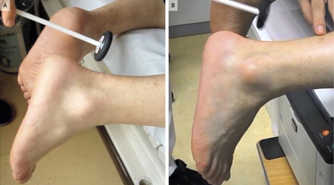 Woltman’s Sign of Hypothyroidism