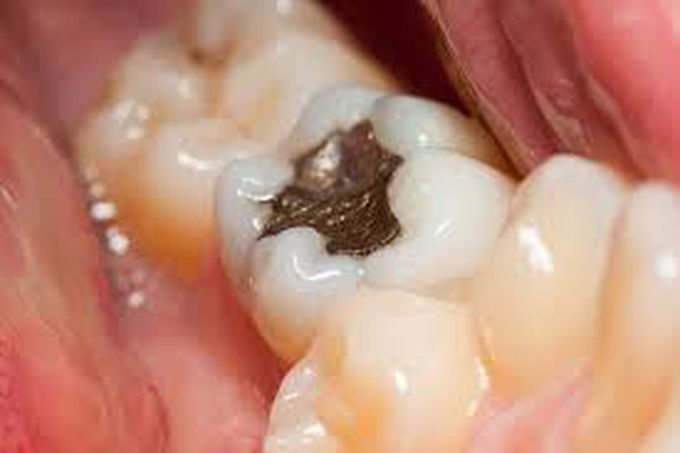 Dental carries
