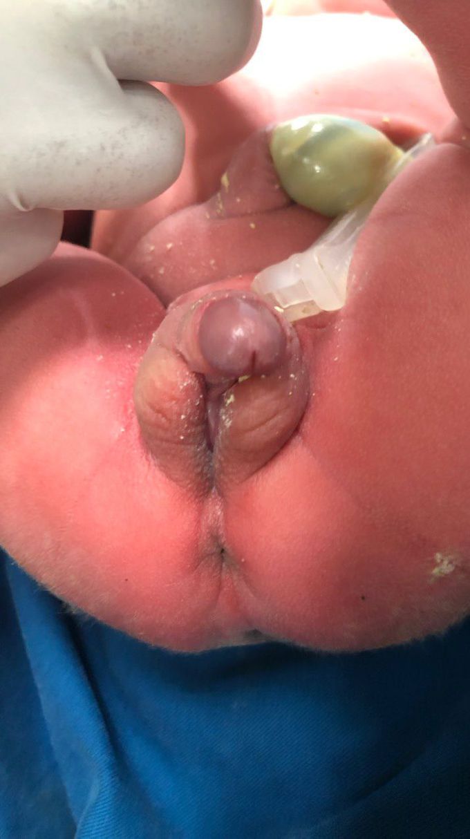 what is the diagnosis for this newborn baby?