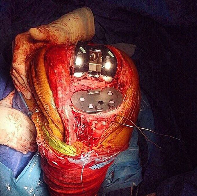 A total knee replacement it is! 