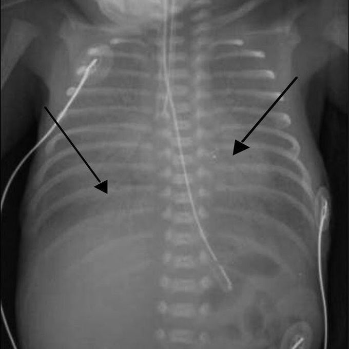 Infant respiratory distress syndrome