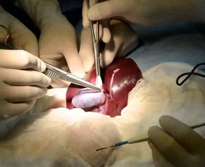 Which surgery??