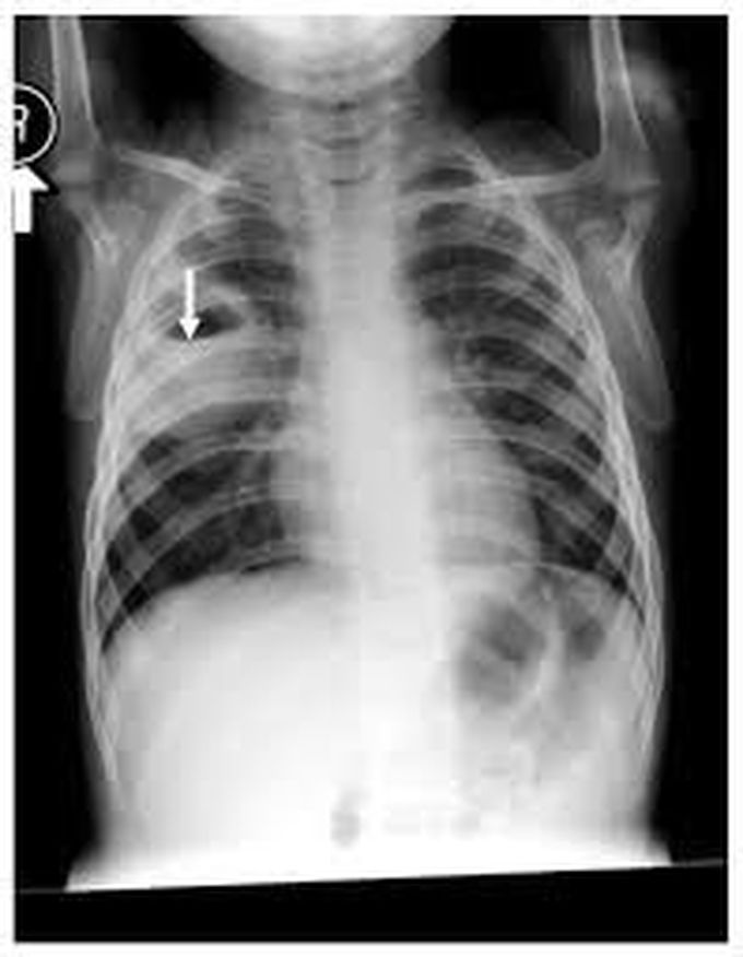 Causes of lung abscess