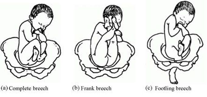 Breech Presentations