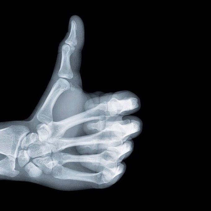 Thumbs up for X-Rays 👍