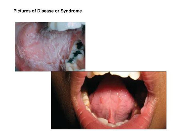 Cannon's disease