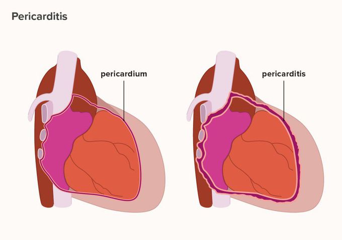 Pericarditis