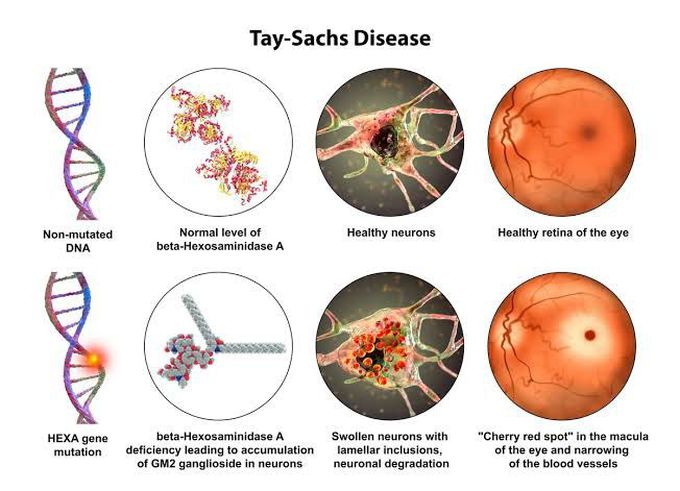 Tay Sachs disease