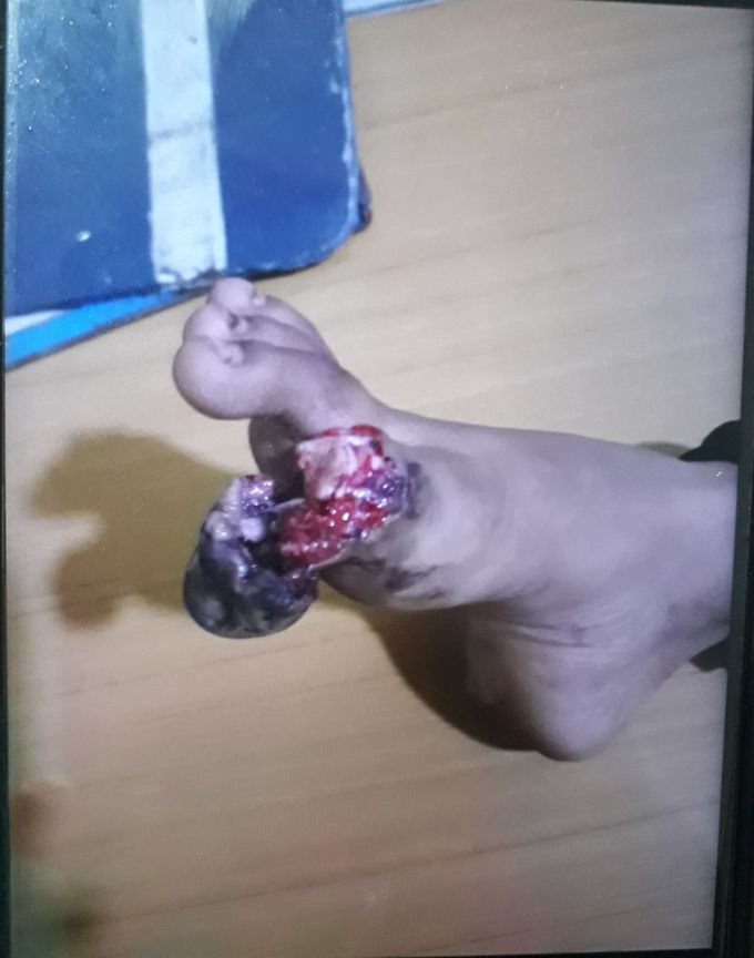 Great toe of a 11 yr girl injured by bicycle's chain